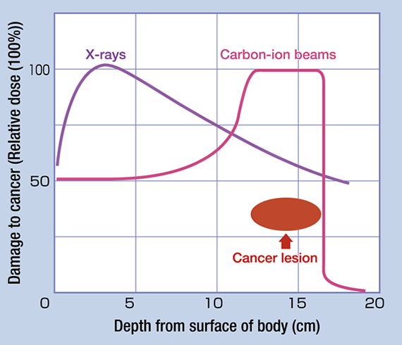 Features of carbon-ion radiotherapy