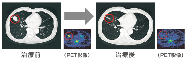 肺がん治療例