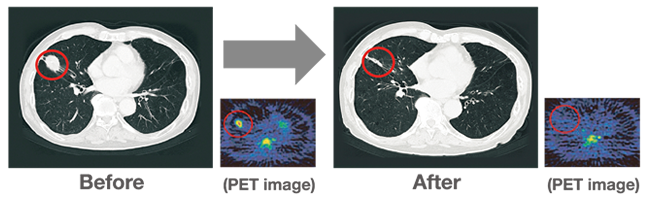 A case treated by carbon-ion radiotherapy